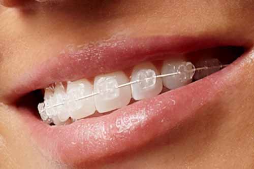 Clear Braces - Dr Ronald Chaiklin