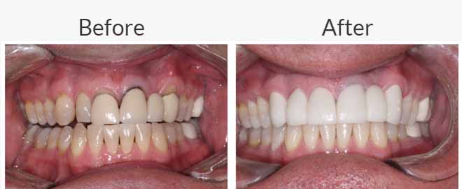 Dental Crowns - Dr Ronald Chaiklin