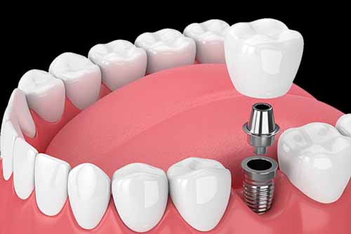 Dental Implants - Dr Ronald Chaiklin