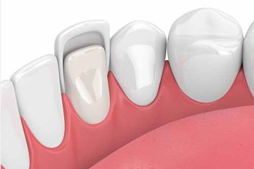 Dental Veneers - Dr Ronald Chaiklin