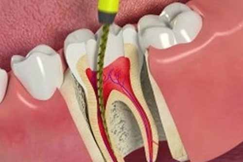 Root Canal - Dr Ronald Chaiklin