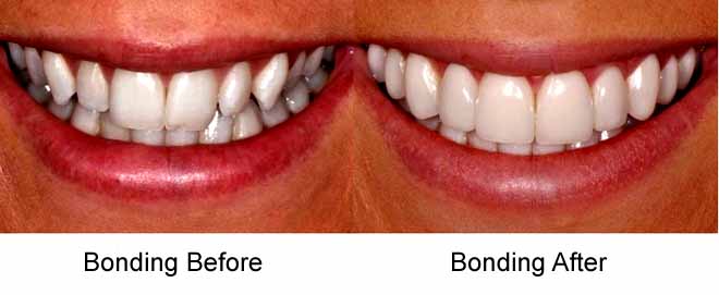 Tooth Bonding - Dr Ronald Chaiklin