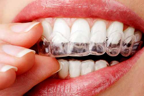 Teeth Grinding - Dr Ronald Chaiklin