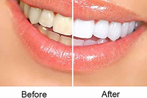 Tooth Whitening - Dr Ronald Chaiklin
